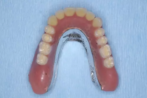 金属床義歯とは