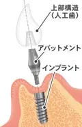 人工の歯の連結