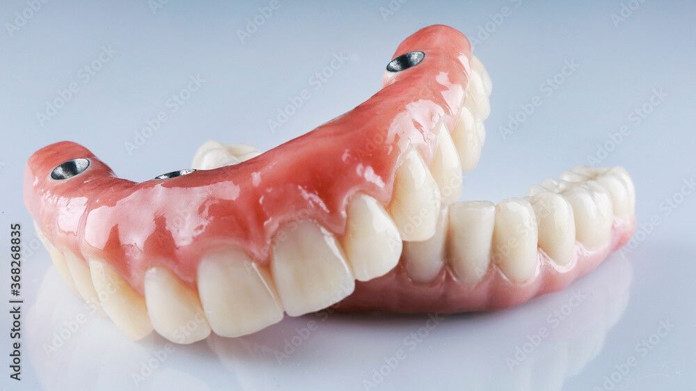 磁性アタッチメント義歯とは
